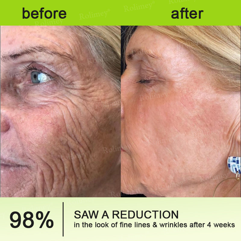 🌟Made and shipped from Canada 💫Rolimey® Botox & Vita-A Retinol Shot Wrinkle-Lift Tightening cream - Last Day Promotion 70% OFF