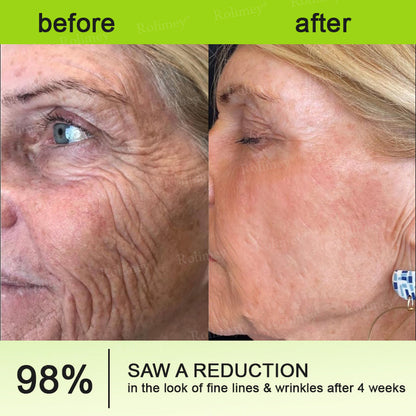 🌟Made and shipped from Canada 💫Rolimey® Botox & Vita-A Retinol Shot Wrinkle-Lift Tightening cream - Last Day Promotion 70% OFF