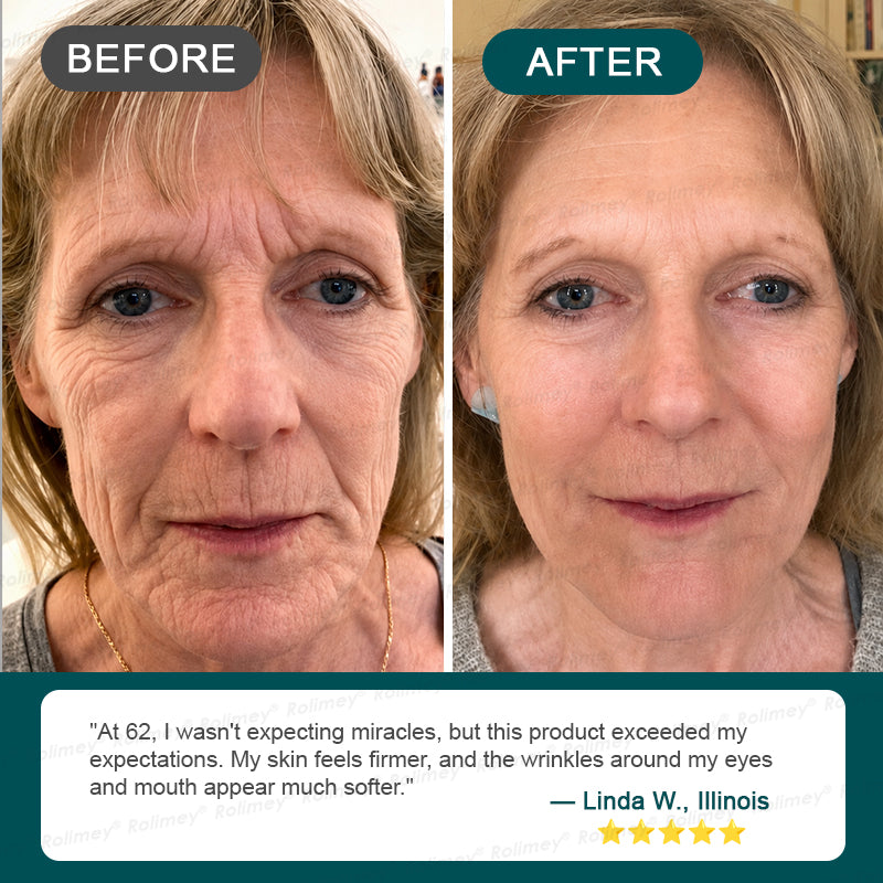 🌿👨‍⚕️CA HOT SALES ✨Rolimey® Botox & Stem Cell Wrinkle-Lift Tightening Cream